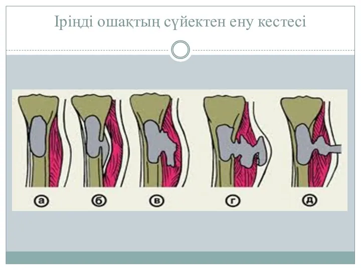 Іріңді ошақтың сүйектен ену кестесі