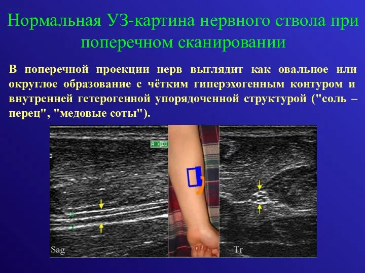 В поперечной проекции нерв выглядит как овальное или округлое образование