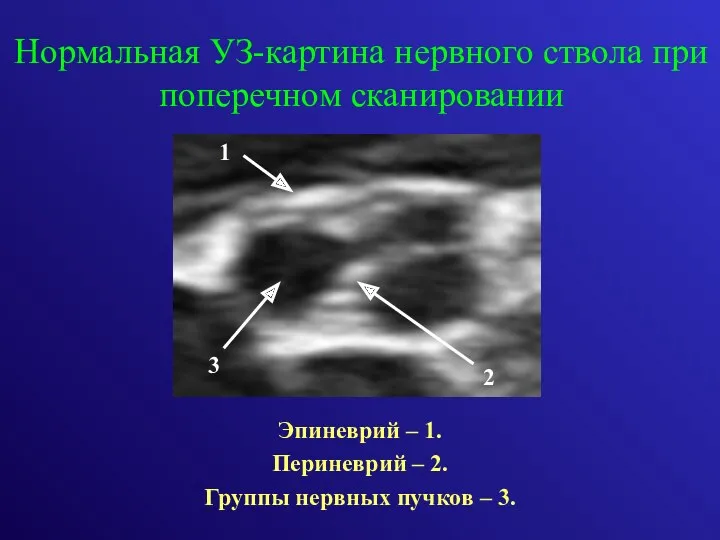 Нормальная УЗ-картина нервного ствола при поперечном сканировании Эпиневрий – 1.