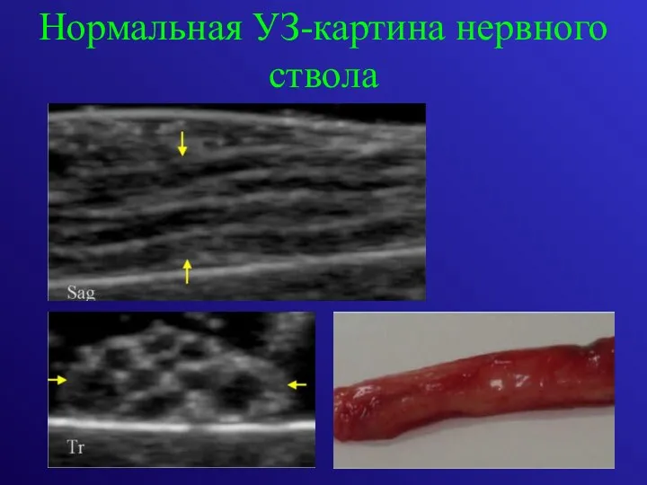 Нормальная УЗ-картина нервного ствола