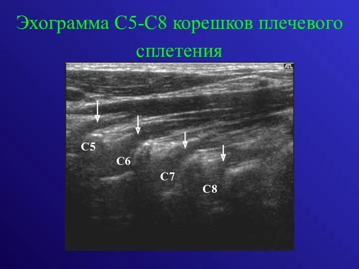 Эхограмма С5-С8 корешков плечевого сплетения