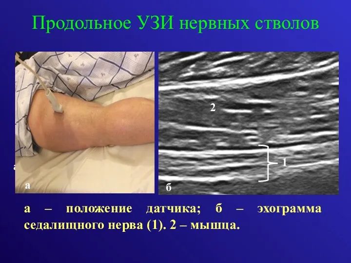 Продольное УЗИ нервных стволов а – положение датчика; б –