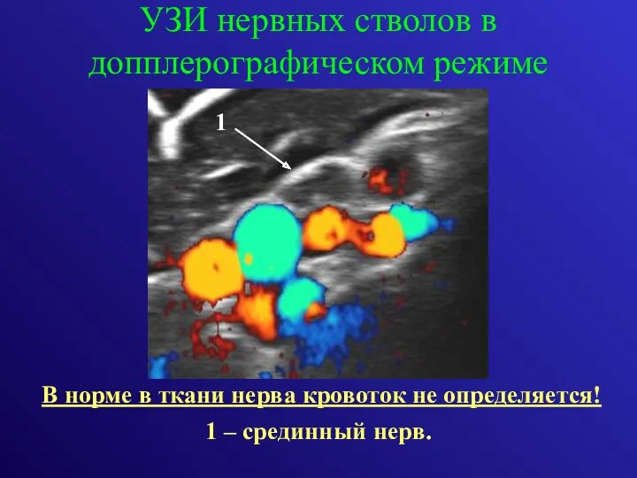 УЗИ нервных стволов в допплерографическом режиме В норме в ткани