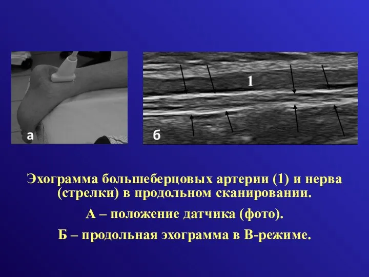 Эхограмма большеберцовых артерии (1) и нерва (стрелки) в продольном сканировании.