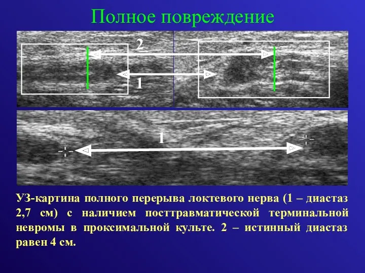 Полное повреждение УЗ-картина полного перерыва локтевого нерва (1 – диастаз