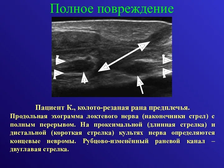 Продольная эхограмма локтевого нерва (наконечники стрел) с полным перерывом. На