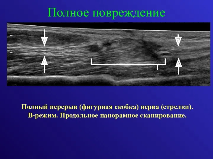 Полный перерыв (фигурная скобка) нерва (стрелки). В-режим. Продольное панорамное сканирование. Полное повреждение