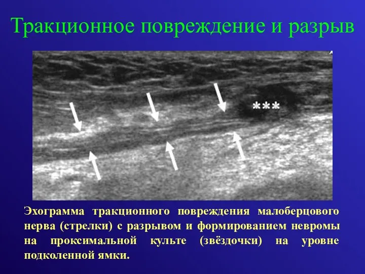 Тракционное повреждение и разрыв Эхограмма тракционного повреждения малоберцового нерва (стрелки)