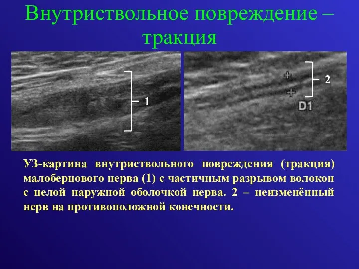 Внутриствольное повреждение –тракция УЗ-картина внутриствольного повреждения (тракция) малоберцового нерва (1)