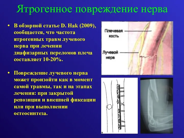 Ятрогенное повреждение нерва В обзорной статье D. Hak (2009), сообщается,