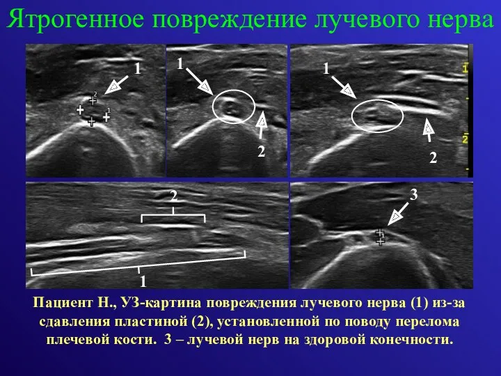 Пациент Н., УЗ-картина повреждения лучевого нерва (1) из-за сдавления пластиной