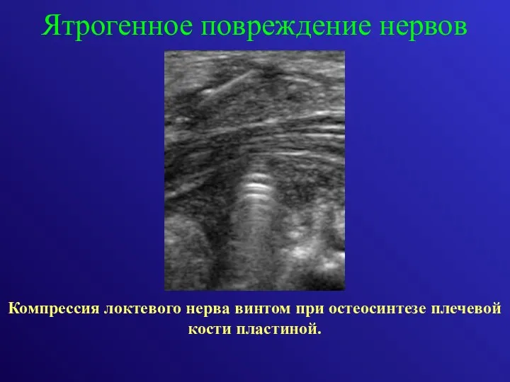 Компрессия локтевого нерва винтом при остеосинтезе плечевой кости пластиной. Ятрогенное повреждение нервов