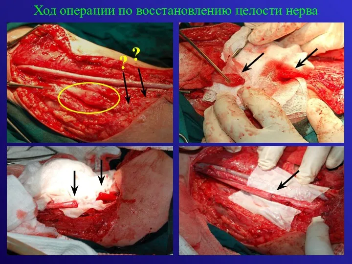 Ход операции по восстановлению целости нерва ? ?