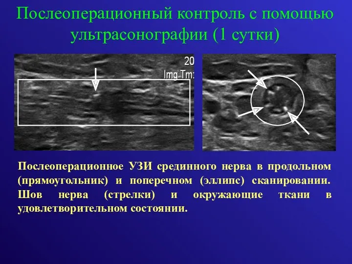 Послеоперационный контроль с помощью ультрасонографии (1 сутки) Послеоперационное УЗИ срединного