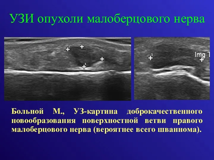 УЗИ опухоли малоберцового нерва Больной М., УЗ-картина доброкачественного новообразования поверхностной