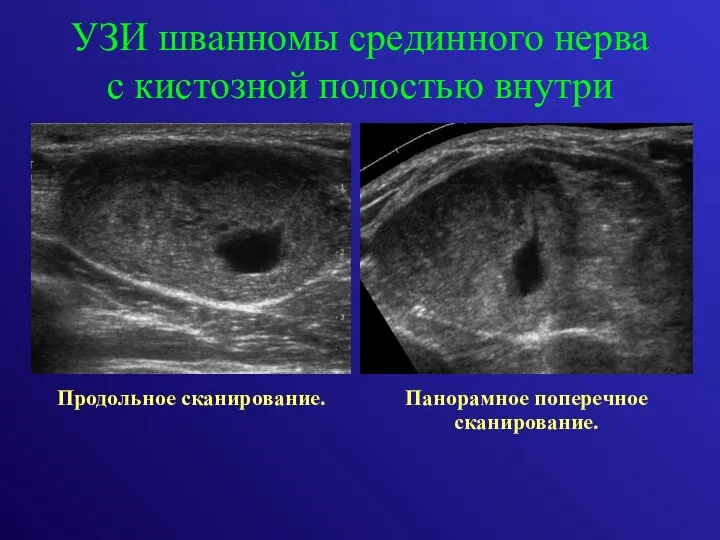 УЗИ шванномы срединного нерва с кистозной полостью внутри Продольное сканирование. Панорамное поперечное сканирование.