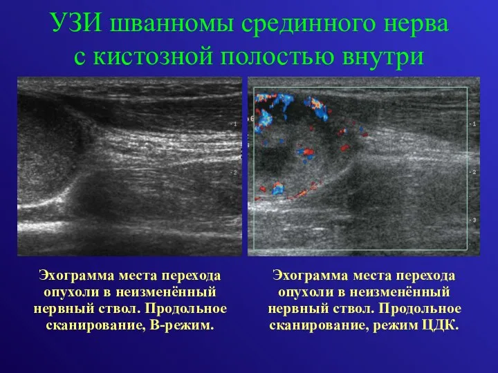 УЗИ шванномы срединного нерва с кистозной полостью внутри Эхограмма места