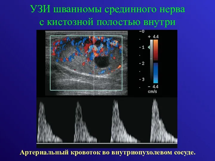 УЗИ шванномы срединного нерва с кистозной полостью внутри Артериальный кровоток во внутриопухолевом сосуде.