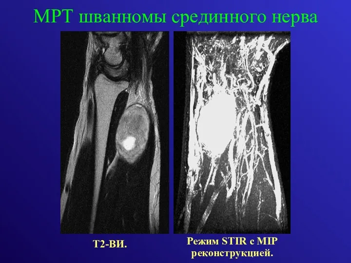 МРТ шванномы срединного нерва Т2-ВИ. Режим STIR с MIP реконструкцией.