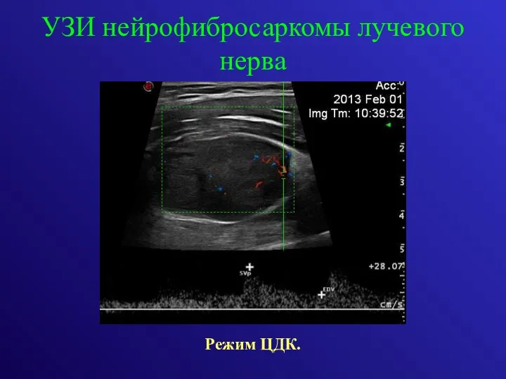 УЗИ нейрофибросаркомы лучевого нерва Режим ЦДК.