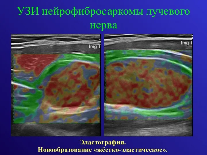 УЗИ нейрофибросаркомы лучевого нерва Эластография. Новообразование «жёстко-эластическое».