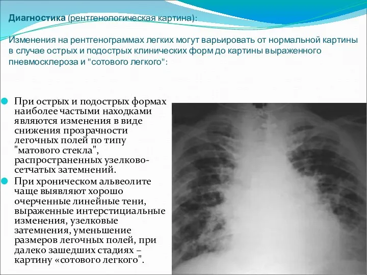 Диагностика (рентгенологическая картина): Изменения на рентгенограммах легких могут варьировать от нормальной картины в