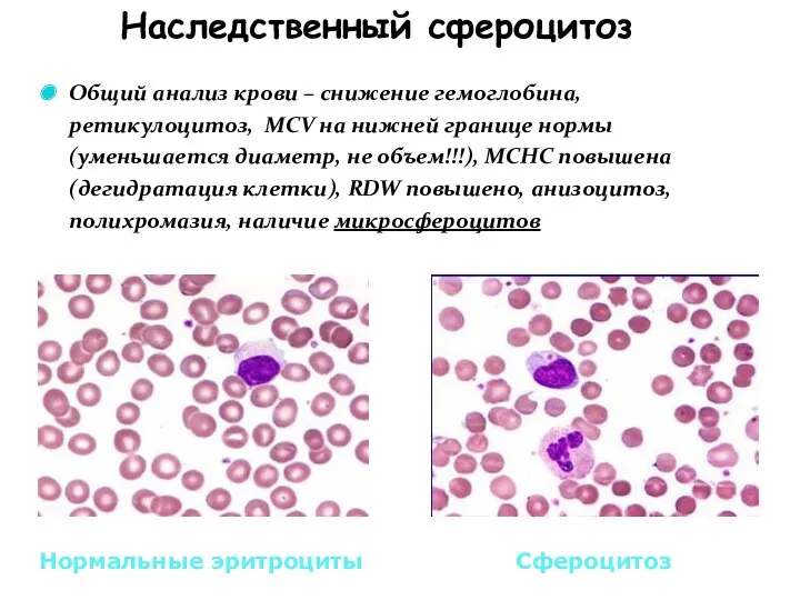 Наследственный сфероцитоз Нормальные эритроциты Сфероцитоз Общий анализ крови – снижение