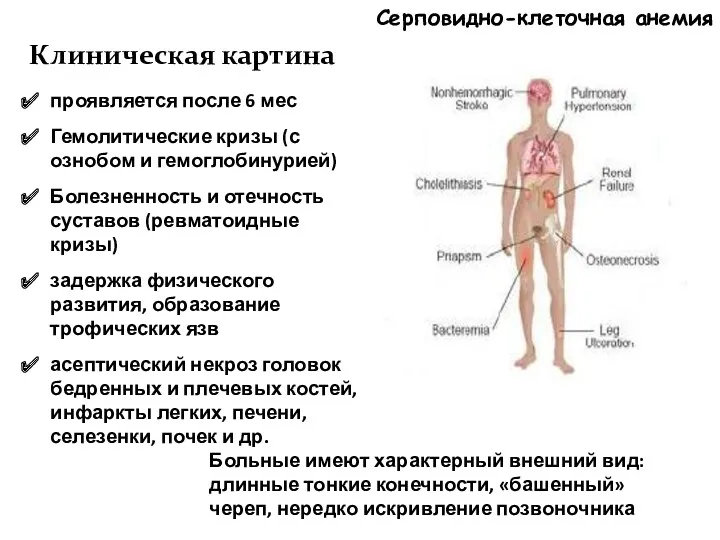 Серповидно-клеточная анемия Клиническая картина проявляется после 6 мес Гемолитические кризы