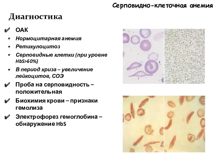 Серповидно-клеточная анемия Диагностика ОАК Нормоцитарная анемия Ретикулоцитоз Серповидные клетки (при