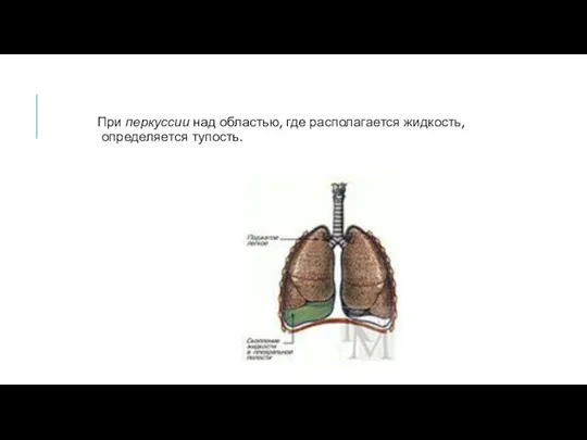 При перкуссии над областью, где располагается жидкость, определяется тупость.