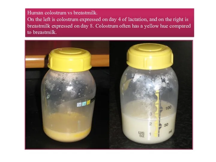 Human colostrum vs breastmilk. On the left is colostrum expressed