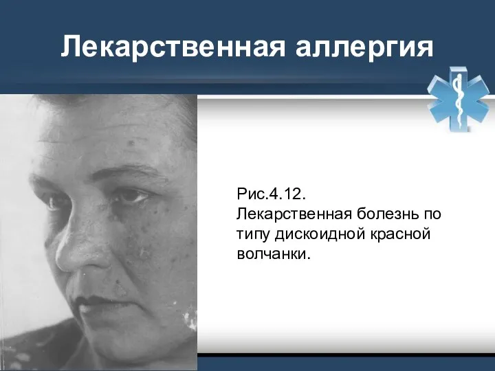 Лекарственная аллергия Рис.4.12. Лекарственная болезнь по типу дискоидной красной волчанки.