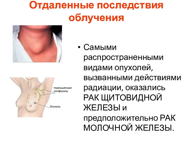 Отдаленные последствия облучения Самыми распространенными видами опухолей, вызванными действиями радиации,