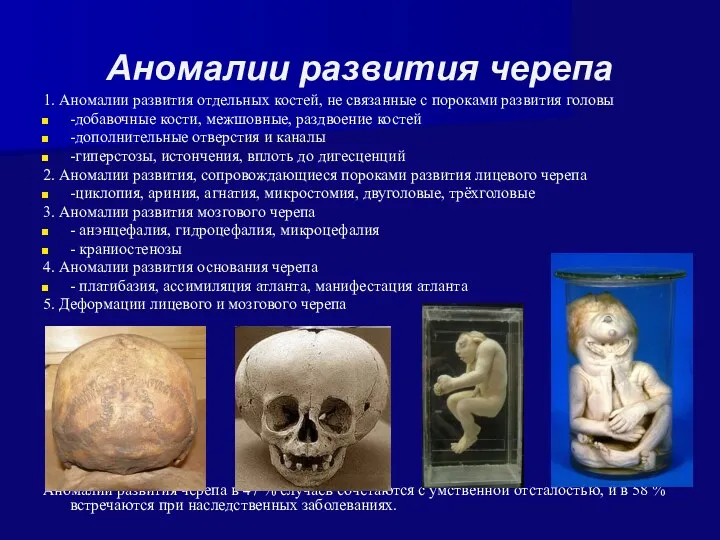 Аномалии развития черепа 1. Аномалии развития отдельных костей, не связанные с пороками развития
