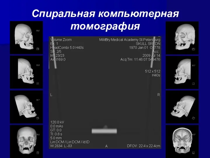 Спиральная компьютерная томография