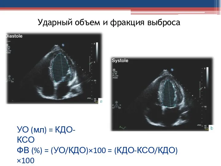 Ударный объем и фракция выброса УО (мл) = КДО-КСО ФВ (%) = (УО/КДО)×100 = (КДО-КСО/КДО)×100