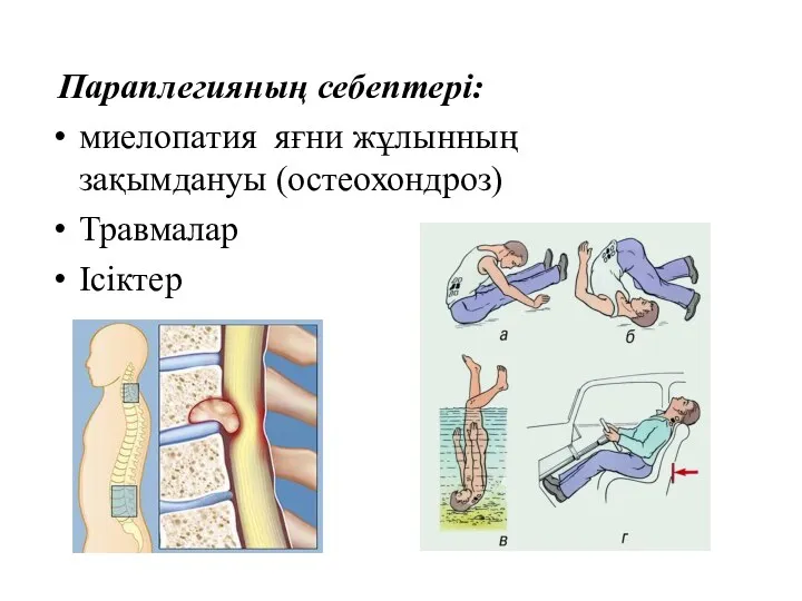 Параплегияның себептері: миелопатия яғни жұлынның зақымдануы (остеохондроз) Травмалар Ісіктер