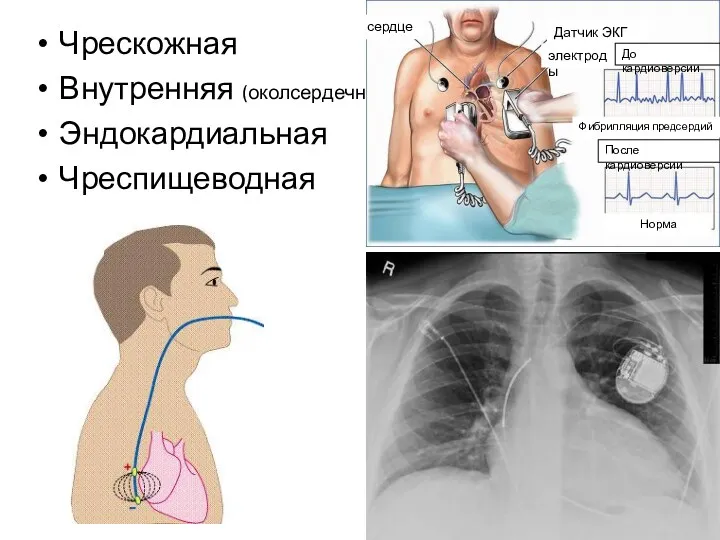 Чрескожная Внутренняя (околсердечная) Эндокардиальная Чреспищеводная сердце Датчик ЭКГ электроды До кардиоверсии После кардиоверсии Фибрилляция предсердий Норма