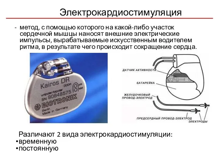 Электрокардиостимуляция - метод, с помощью которого на какой-либо участок сердечной