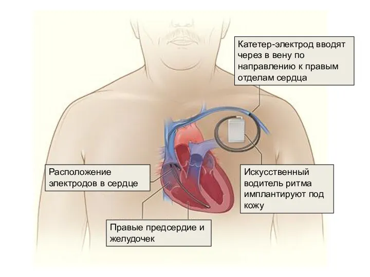 Искусственный водитель ритма имплантируют под кожу Катетер-электрод вводят через в