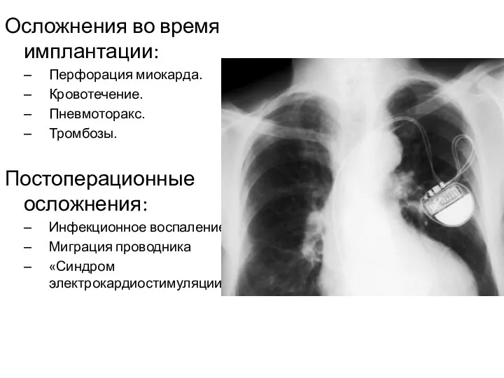 Осложнения во время имплантации: Перфорация миокарда. Кровотечение. Пневмоторакс. Тромбозы. Постоперационные