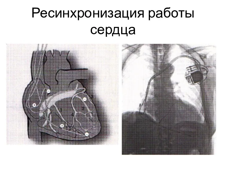 Ресинхронизация работы сердца