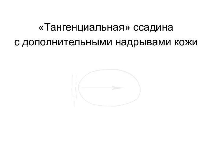 «Тангенциальная» ссадина с дополнительными надрывами кожи