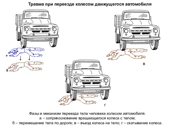 Травма при переезде колесом движущегося автомобиля Фазы и механизм переезда