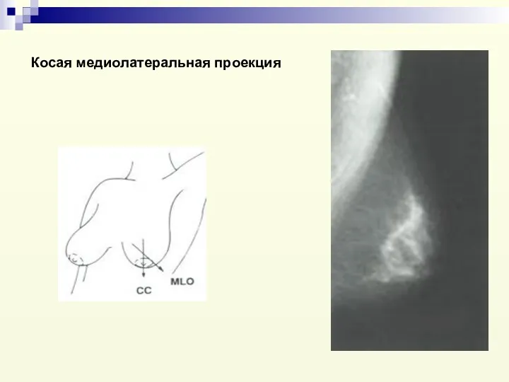 Косая медиолатеральная проекция