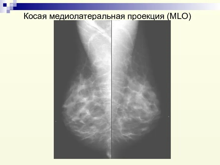 Косая медиолатеральная проекция (MLO)