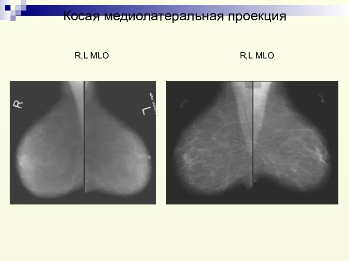 Косая медиолатеральная проекция R,L MLO R,L MLO