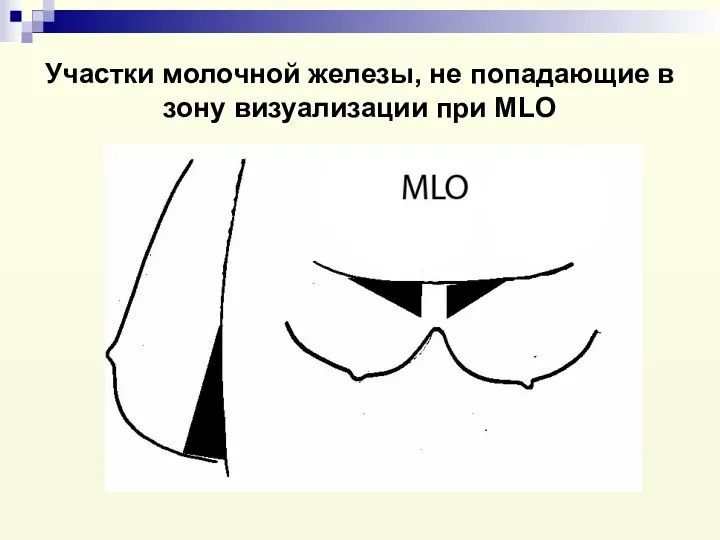 Участки молочной железы, не попадающие в зону визуализации при MLO