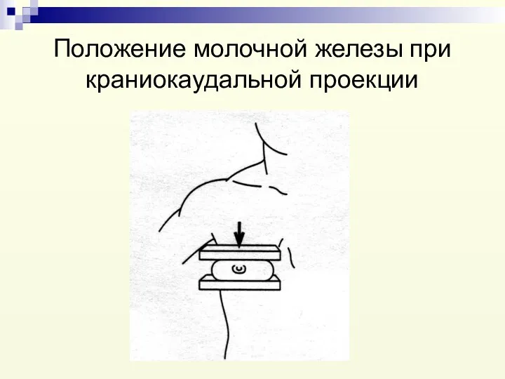 Положение молочной железы при краниокаудальной проекции