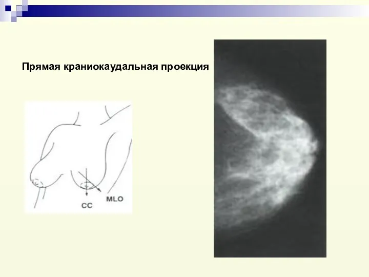 Прямая краниокаудальная проекция